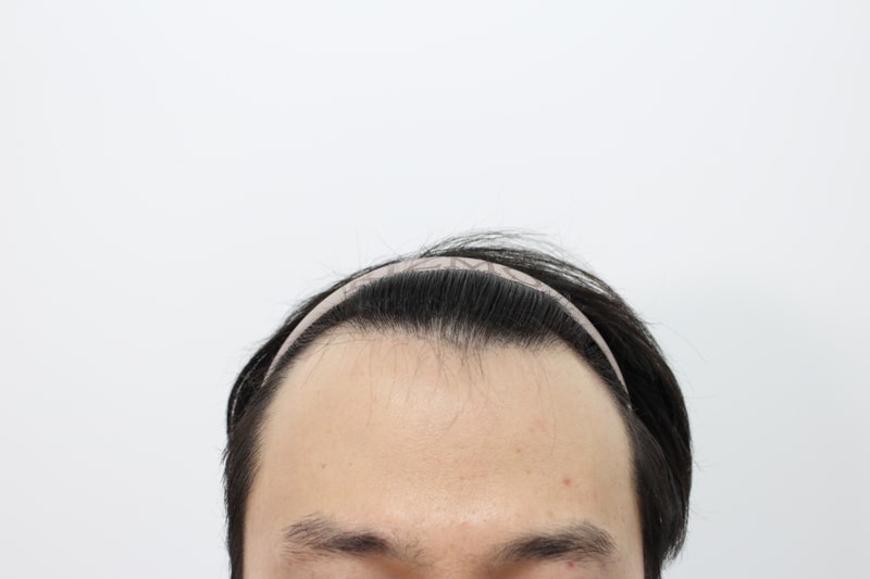 [부산 리즈모의원] 모발이식 12개월 경과