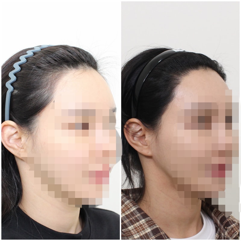 모프로의원,문건학원장님,헤어라인교정,11개월차 