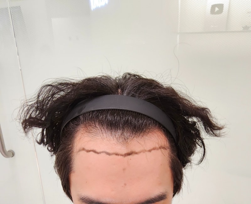 Director Kim Yong-bin's m-shaped non-cut Hair Transplant 3,500 Mo's two-week review