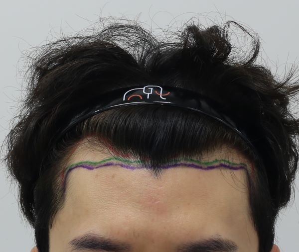 Apgujeong Mammoth Hair Restoration Center M-shaped non-cut slit hair transplantation 7 months later