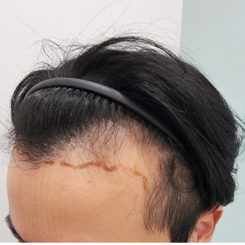 9개월차 모디헤어플란트 모발이식 경과 공유함 ㅇㅇ