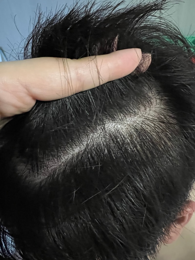 ニューヘアー 植毛3か月目の体験談