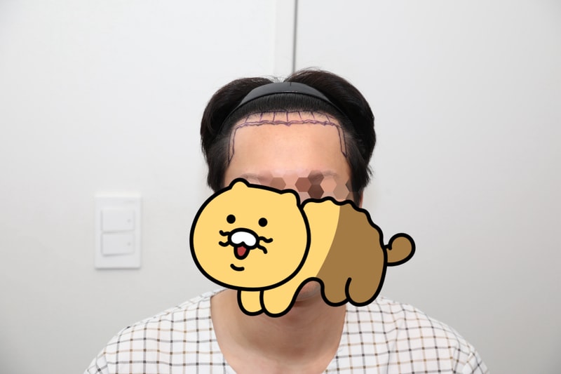 뉴헤어 10개월차 비절개 1900모낭 모발이식 후기