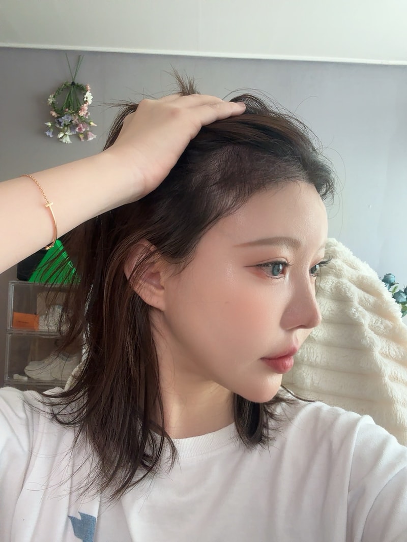대전 리즈모에서 모발이식 받고 벌써 3개월 지났어요!!