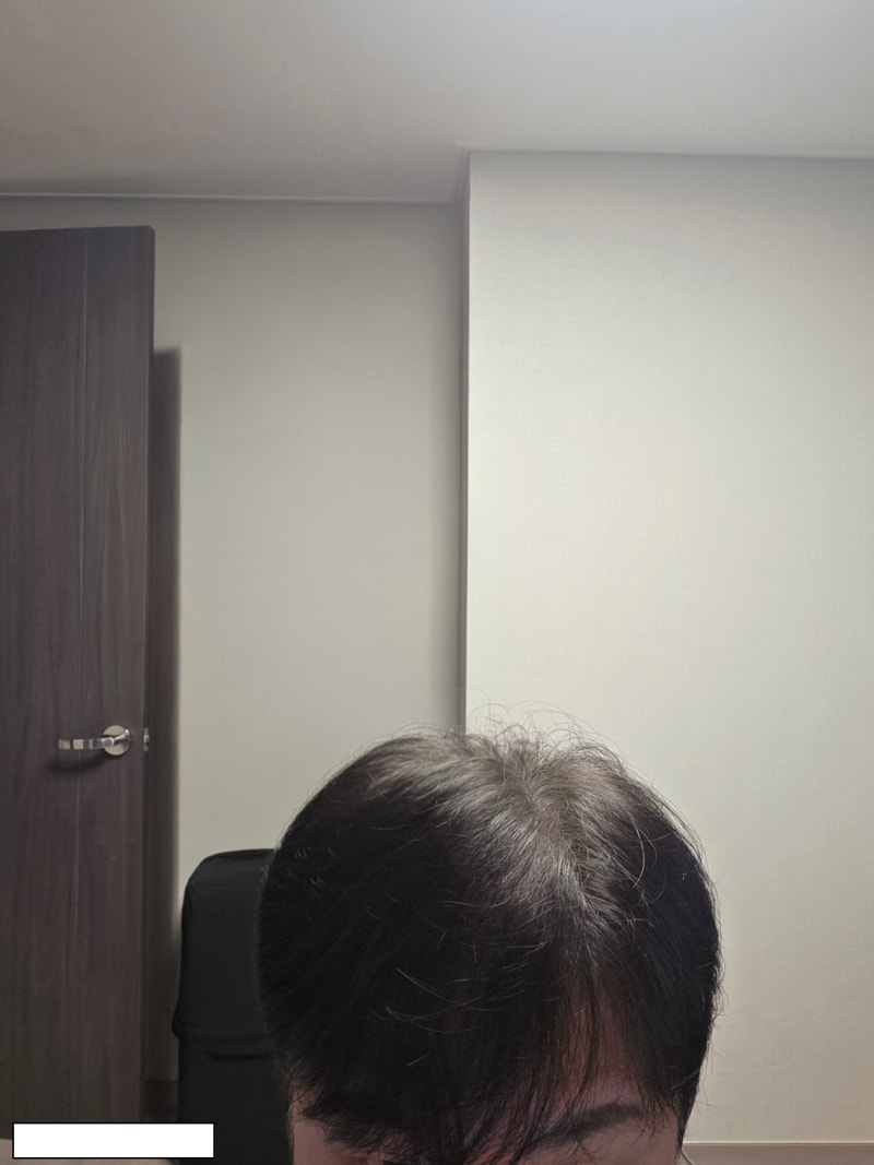 NEWHAiR incision 1500 hair follicle Hair Transplant 7 months later