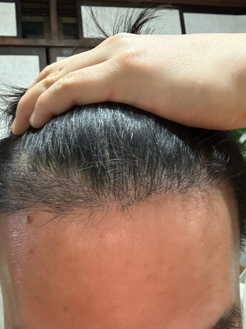NEWHAiR's 3rd Month Hair Transplant 1800 Follicular Review