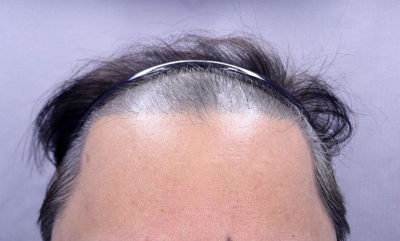 This is the review of the Yonsei Movelle Incheon Hair Transplant 3000mo.