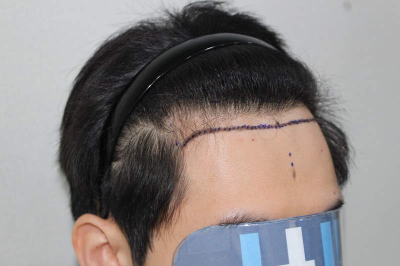 Late 15 days after non-excisional Hair Transplant 2057 mock surgery at Moderna's Hospital