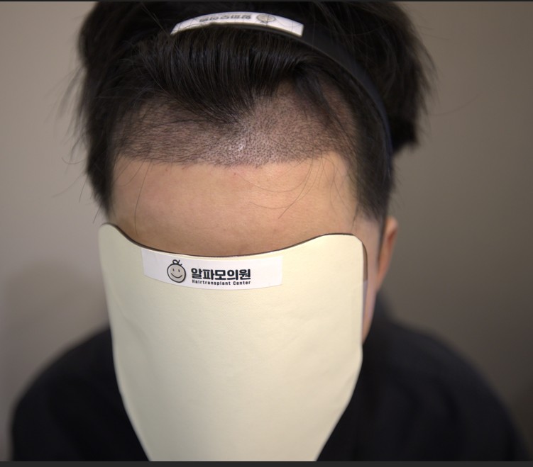 알파모의원에서 비절개 헤어라인 수술했습니다 