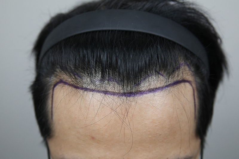 Top of the head 3000 Mo Hairline 2000 Mo Total 5000 Mo Nara Hair Transplant