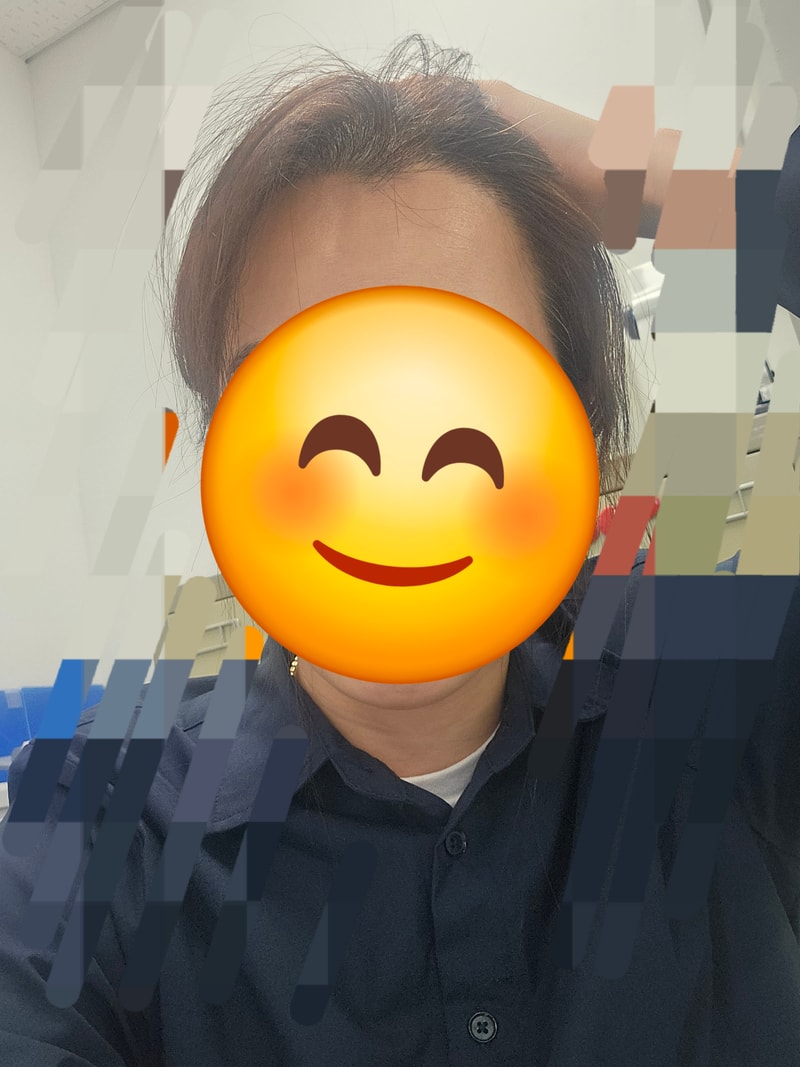 동탄 헤어로의원 모발이식 1800모 1년차 후기