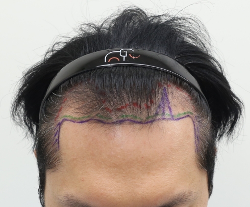 <4 months have passed since the end of the non-intersecting Hair Transplant of the Apgujeong Mammoth Hair Restoration Center>
