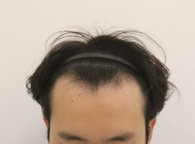 부산맘모스 비절개 M자 8개월 경과 후기