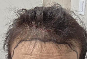 여자 M자 헤어라인 절개이식 후기입니다.