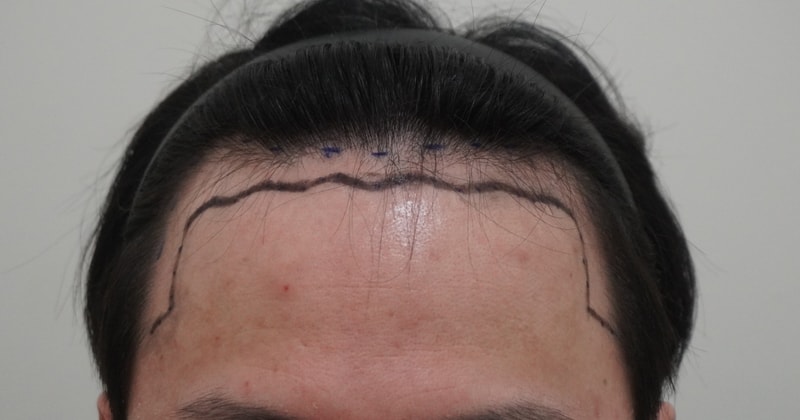 [Director Park Sang-hyun] Review of M-shaped Hair Transplant 3,200mo surgery on the day.
