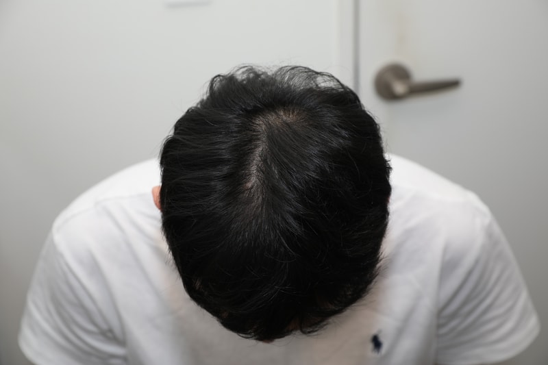 뉴헤어 모발이식 비절개 365일차 후기입니다.
