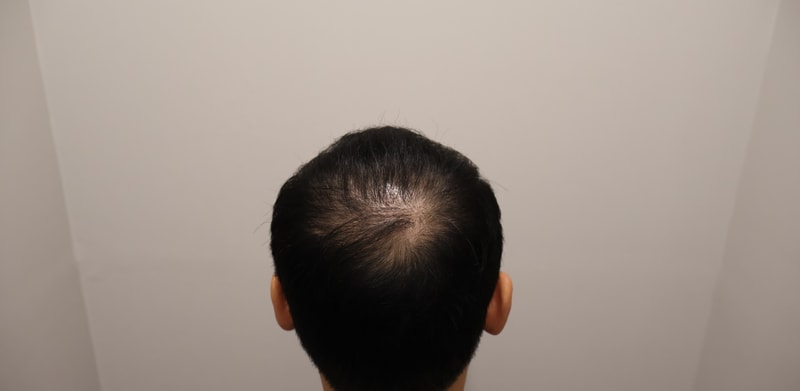모발이식 1년 경과