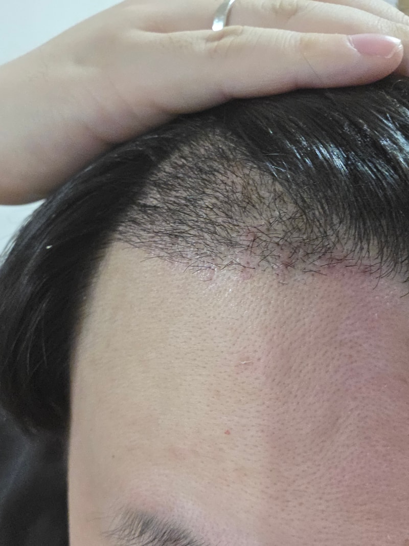 MYMO HAIR TRANSPLANT CENTER Incheon Week 2 Review
