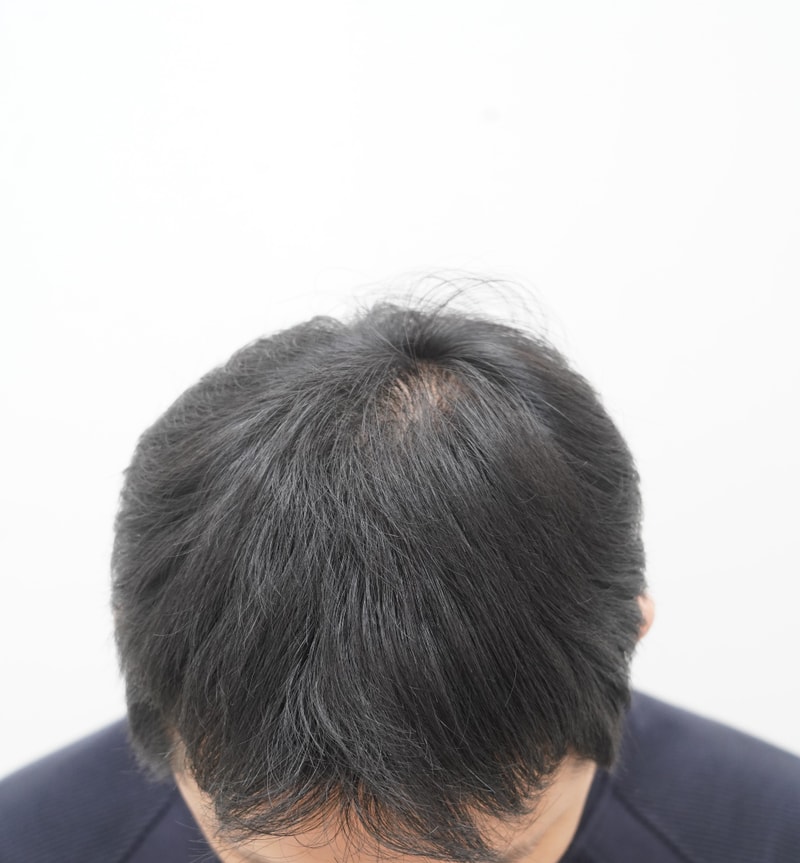 [연세모나의원]전두 및 가마 2000모낭 이식 후 7개월차 솔직 후기