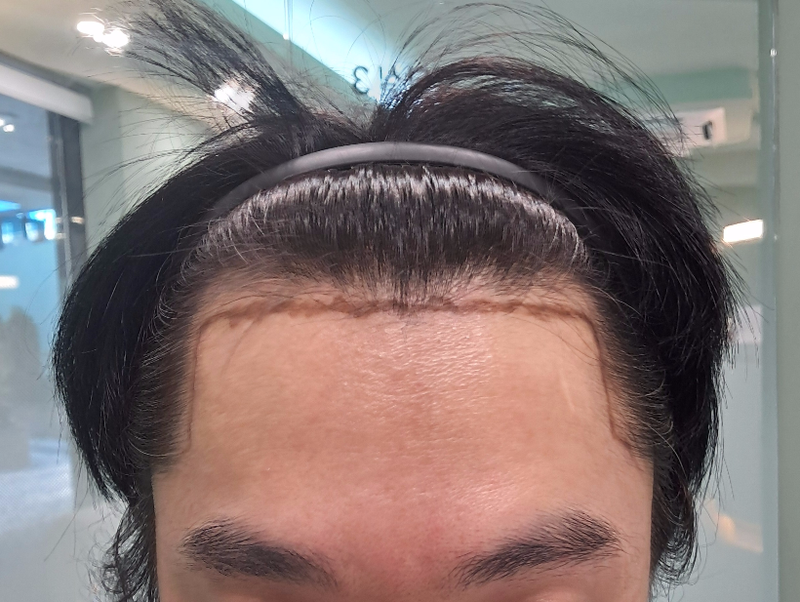 상담만 받아보자 하고 갔었던 이식 상담 투어