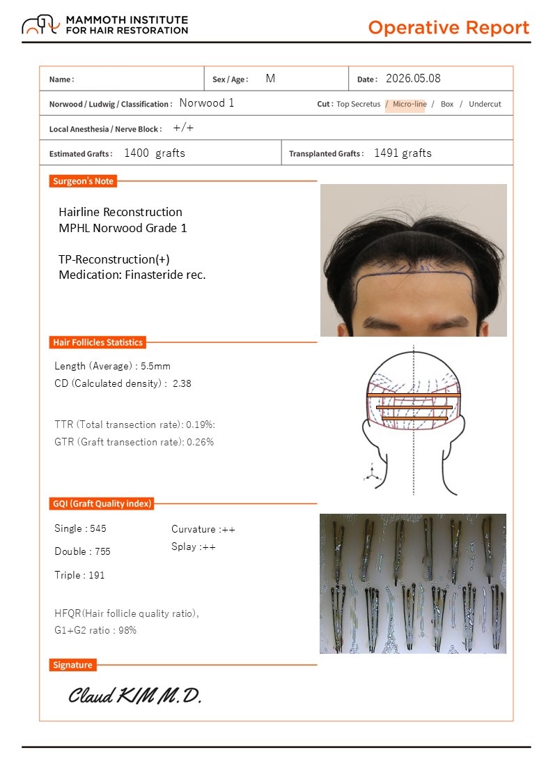 부산 맘모스 비절개 사파이어슬릿 M자 모발이식 1일차
