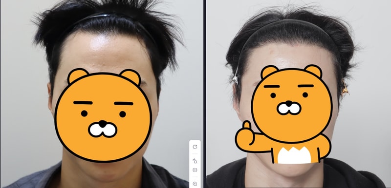 (9개월차)2900모 비절개모발이식 라인컷 남자 후기