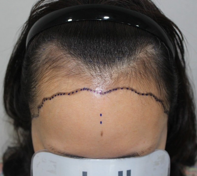 Hannaeve plastic surgery，女性额头下垂、深邃的M字~侧面也接受手术的当天后记