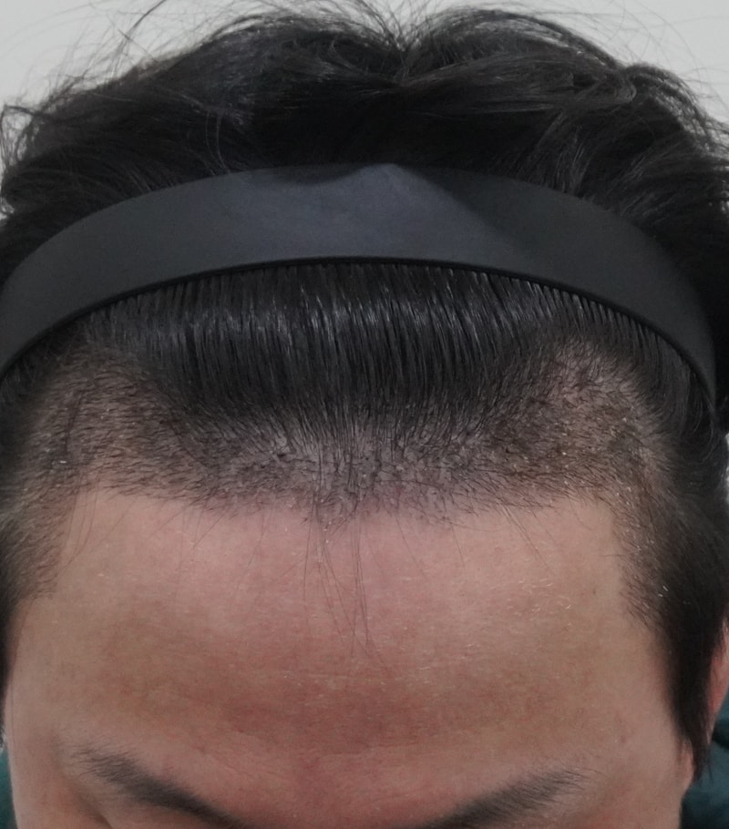 [Director Park Sanghyun] M-shaped Hair Transplant 3,200 Mo, 2 weeks review.