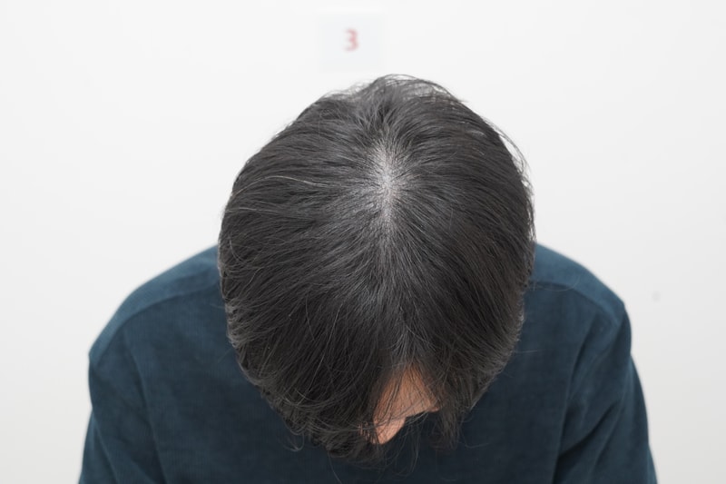 정수리 모발이식 받고 4개월 차 후기입니다
