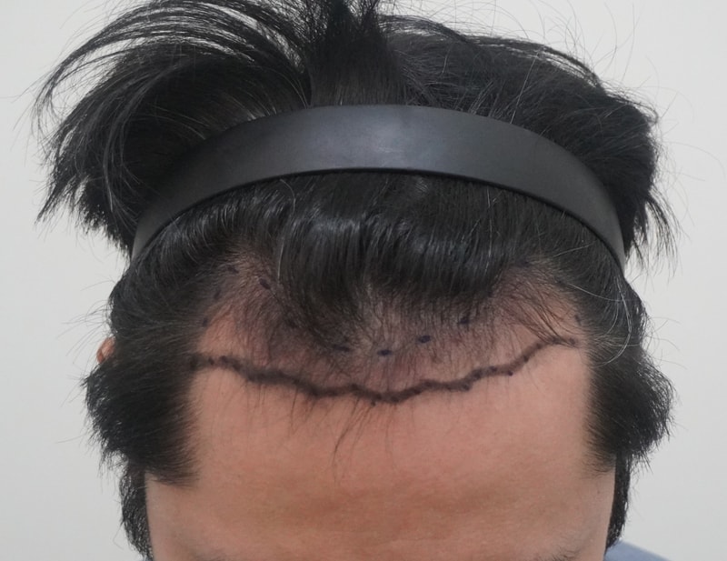 용닥터 박상현원장님 모발이식 2주차 후기! 밀도 라인 보이기 시작! 