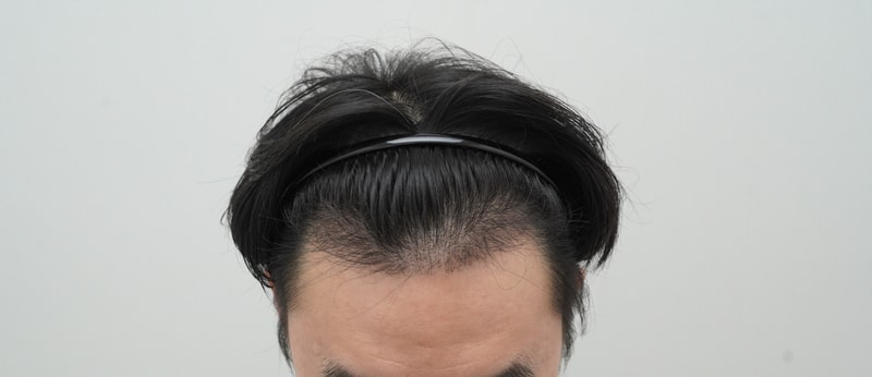머리 심은지 드디어 4개월이 차 진입했습니다..! 