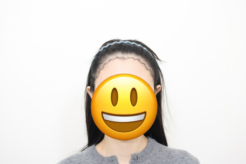 新沙洞毛芙乐毛发诊所/ 发际线移植 1700 毛 再手术/6个月