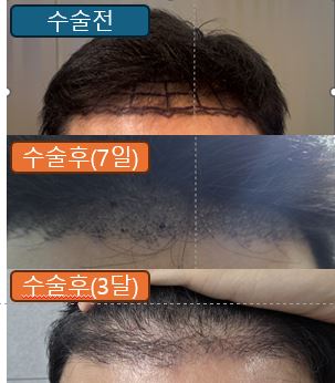 강남 뉴헤어 모발이식 3달 차 후기 (비절개·무삭발 / 1600모낭)