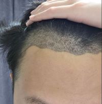 대구 헤어로 의원 2개월차 후기
