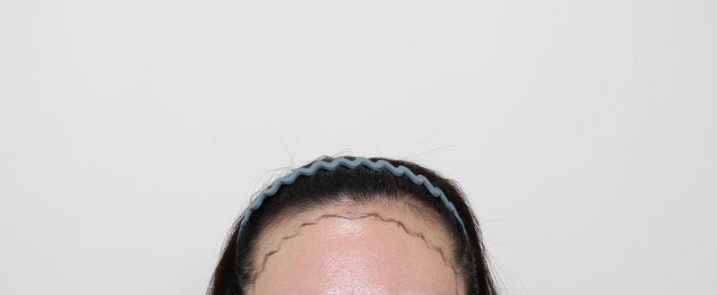 Mopro Clinic Hairline + Gouretnaru 11th Day Review