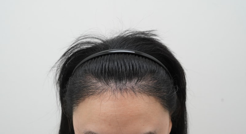 [연세모나의원]M자 넓은 이마 비절개 1700모낭(약4300모) 이식받고 암흑기 탈출 중인 4개월차 리얼 후기 여자에요~