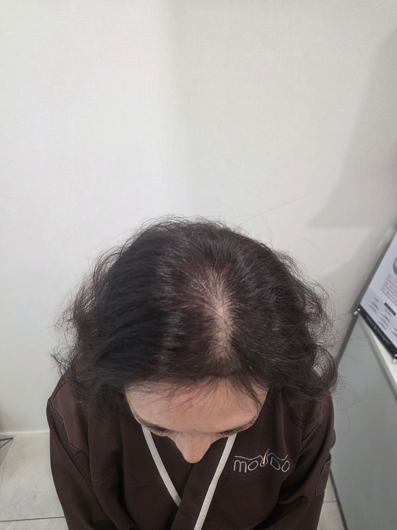 ヘアライン、分け目、頭頂部の非切開2500本移植