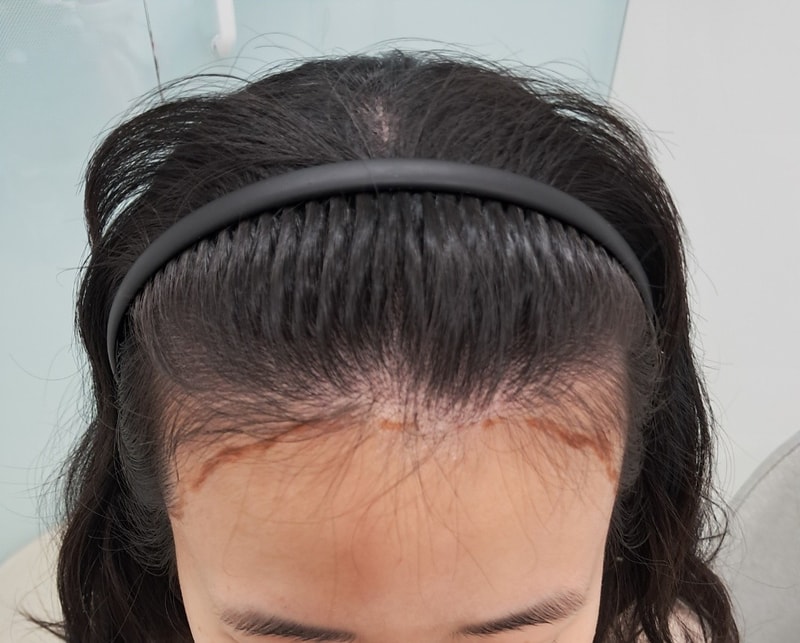 You can get Hair Transplant and full-back hair! A review