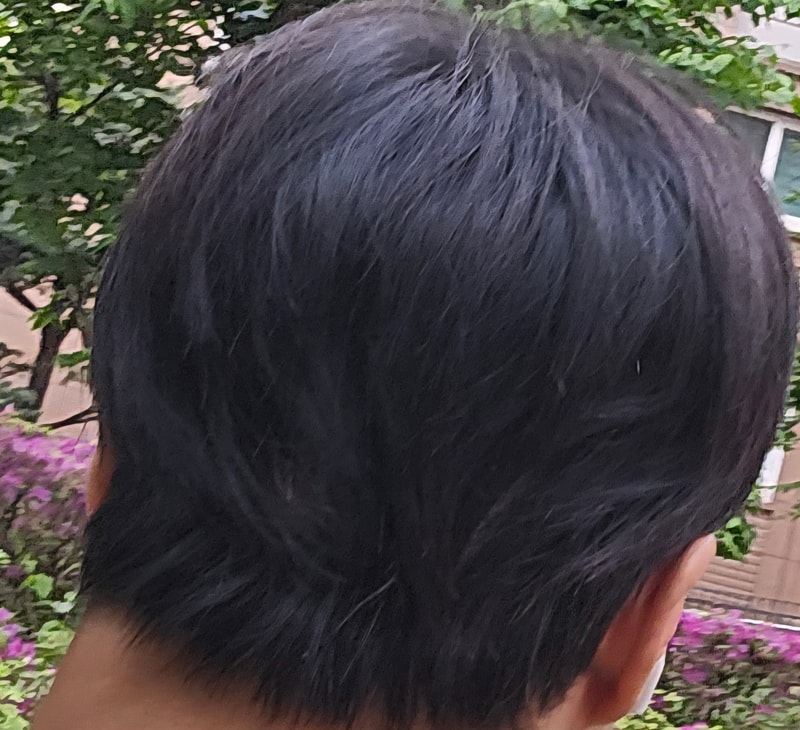 헤어라인 모발이식 4000모..