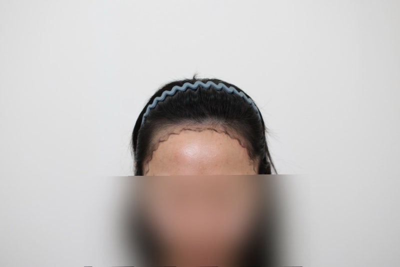 *모프로의원 비절개 4100모 생생 후기임다*