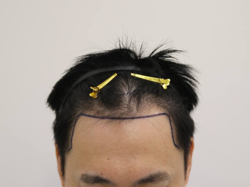 釜山マンモスヘアラインクリニックヘアラインクリニックのM字、非切開4か月体験談です