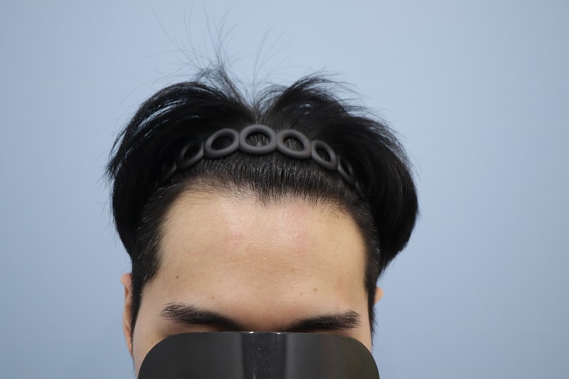 광주 압구정모비앙의원 모발이식 10개월 경과 후기