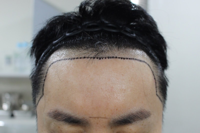 M자수술 1년 좋아졌습니다 양유균원장님 감사!!!