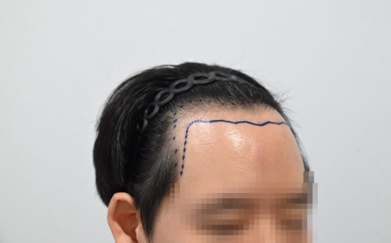[전지훈 원장님] 비절개 3800모 4주차에 접들며 써는 후기