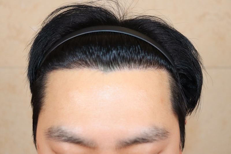 [수술1년차] 압구정 움찬의원 모발이식 수술 후기