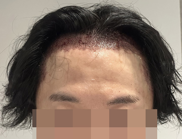 2200모낭 남성 헤어라인 교정 - 압구정 모우림의원