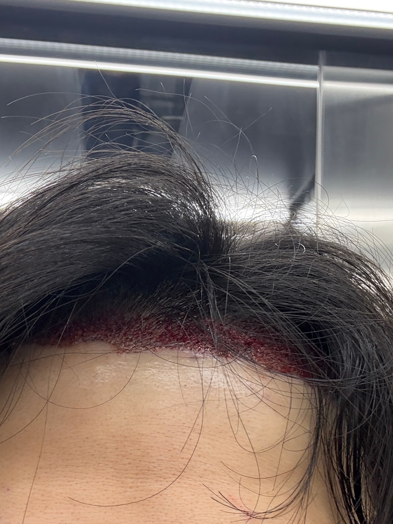 수술 후 40일 라이트한 경과 보고