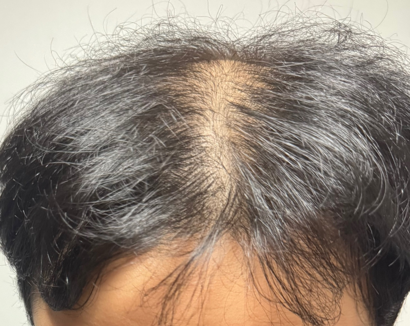 I've been doing stem cell therapy for a year and four months at Modi Hair Implant