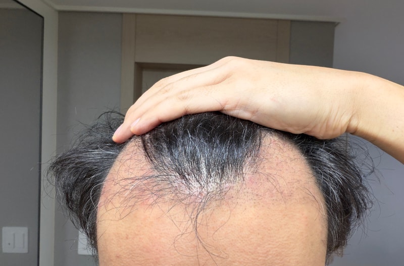 깊은 M자 5600모 모발이식 세달차