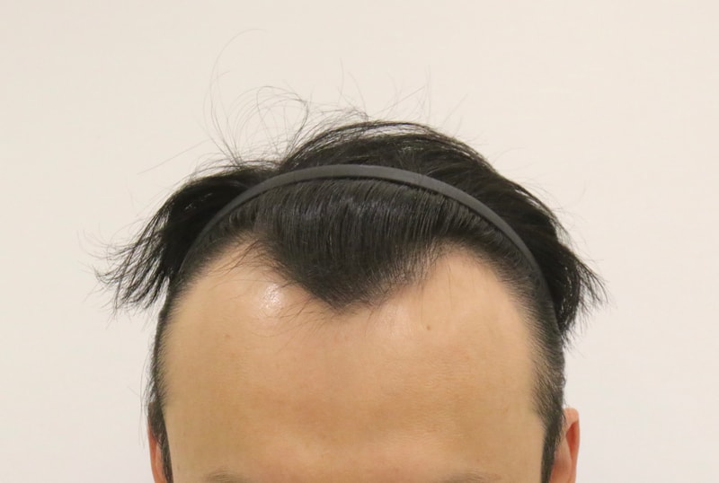Busan Hair Transplantation Slit Method Mammoth Hair Restoration Center Deep M-shape for 8 months